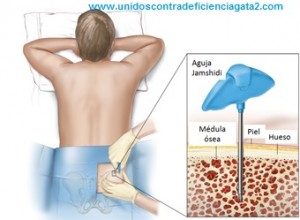 biopsia médula osea