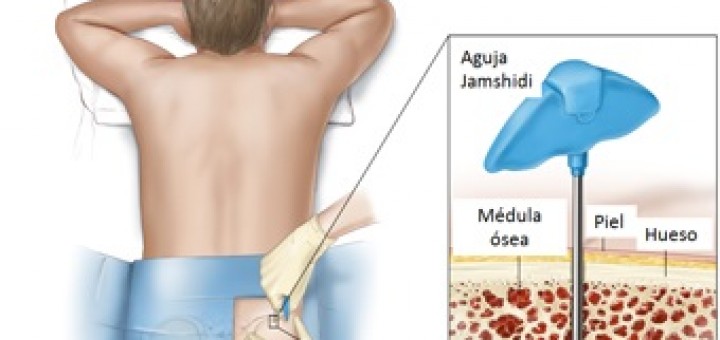 biopsia médula osea